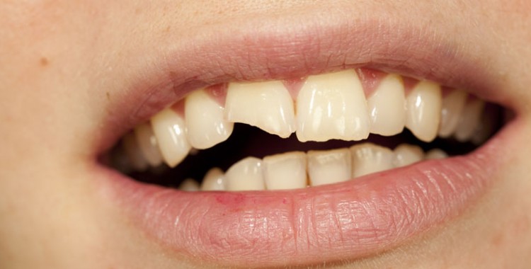 Broken Tooth | Cracked Tooth | Box Hill Dental