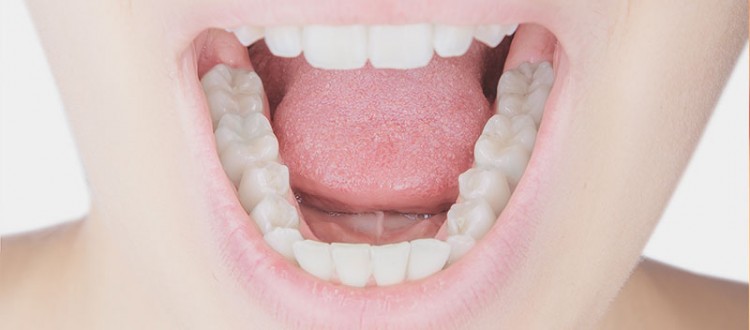 composite fillings